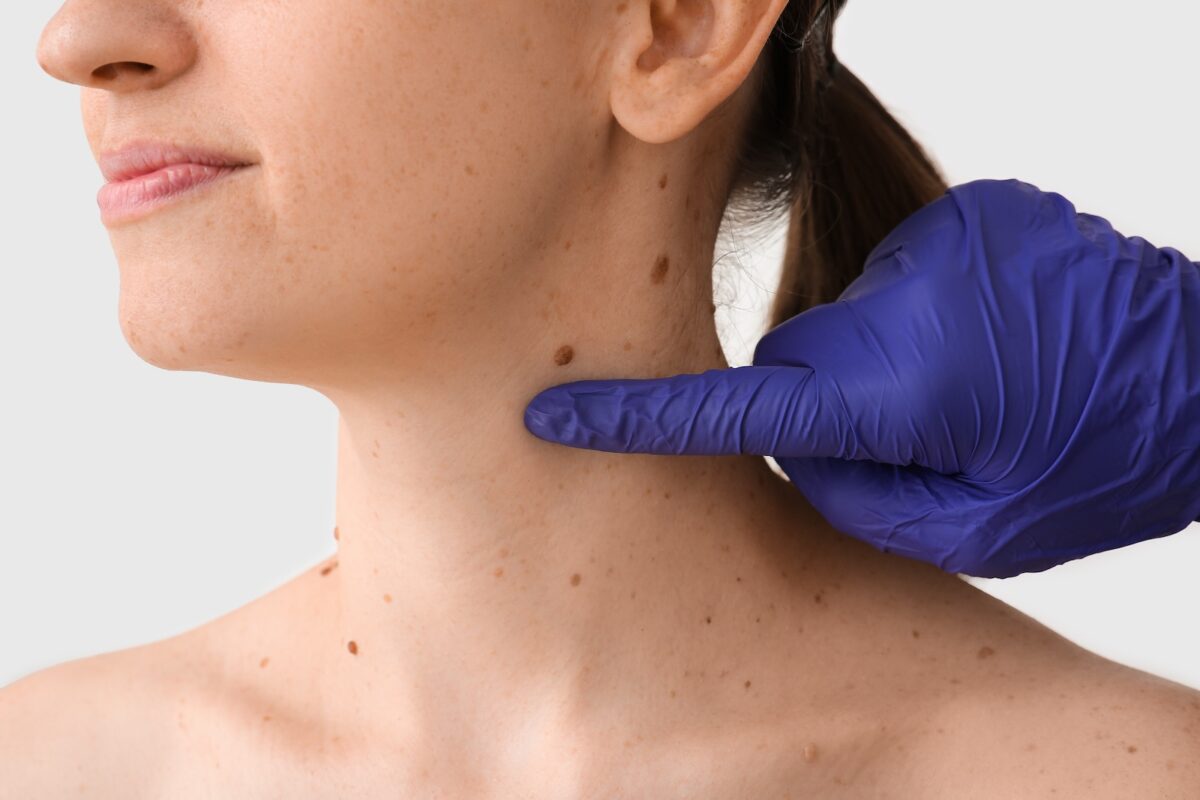 cancer-peau-risques-du-bronzage-trop-sous-estimes